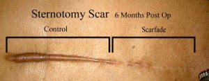 Sternotomy Scar Before and After Scarfade scare gel