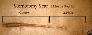 sternotomy-scar Sternotomy Scar Before and After Scarfade scare gel