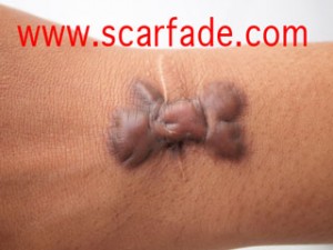 keloid scar treatment
