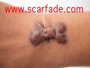 keloid scar