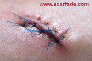 Sutures