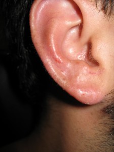 ear-scar